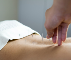 Foto van een acupunctuur behandeling op de onderrugwaarbij de acupunctuurnaalden in de rug gezet worden. De techniek die toegepast wordt is de Prof Shan methode.