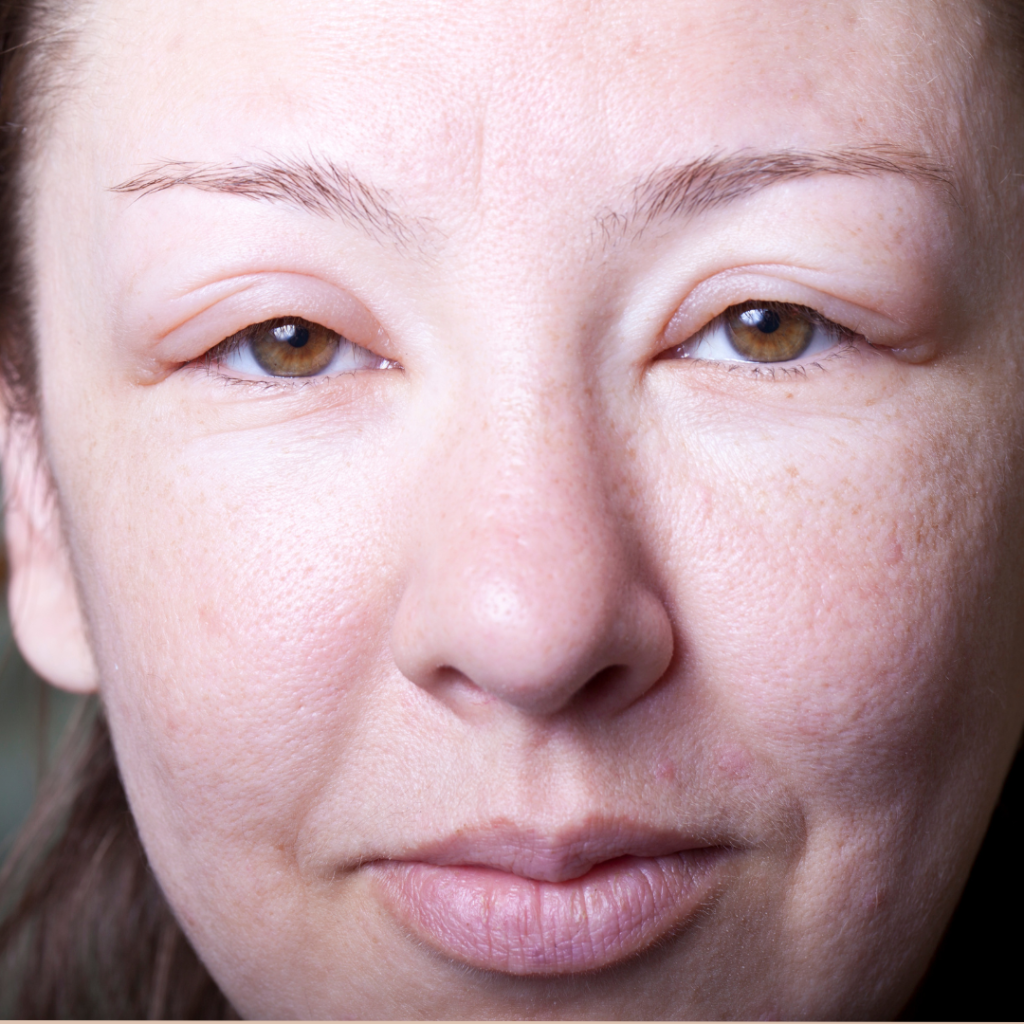 Oedeem in het gezicht TCM TCG acupunctuu chinese kruiden